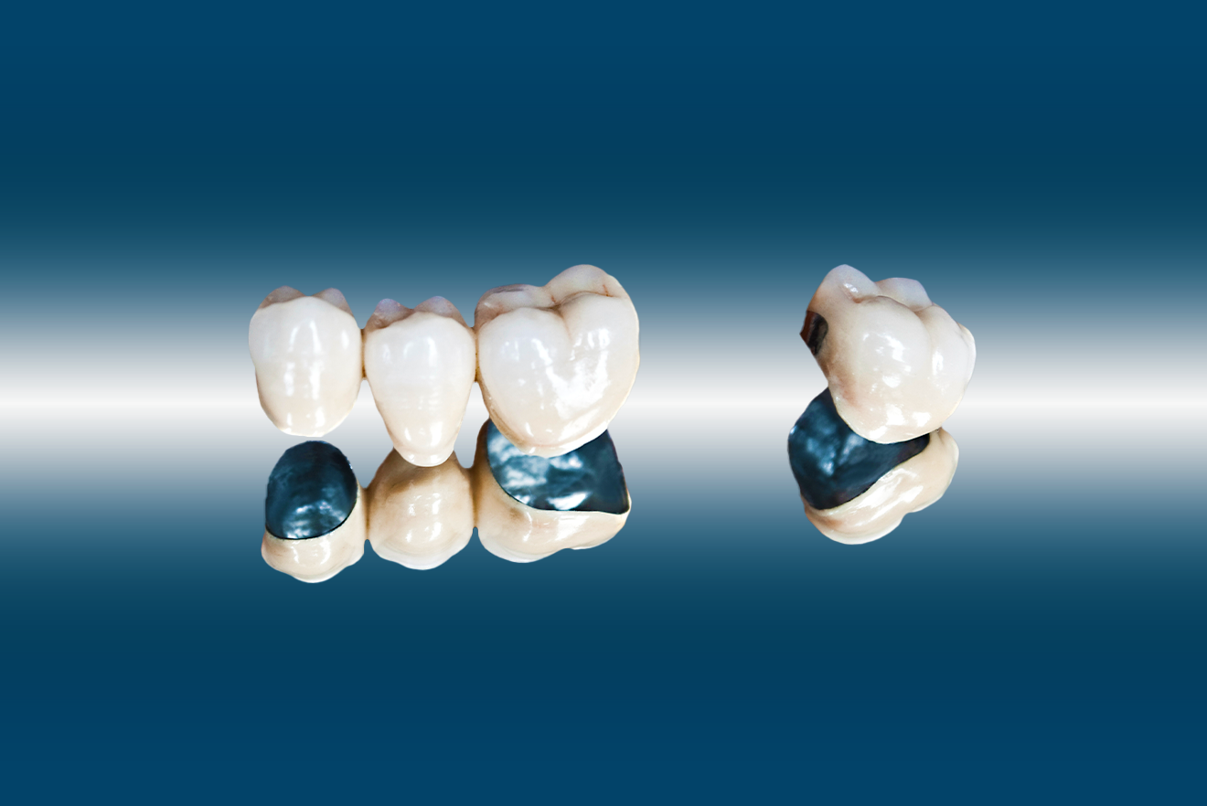 Porcelain-fused-to-metal Crown