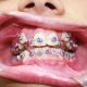 treatment with braces