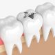Amalgam Fillings