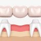 dental bridge