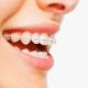 Ceramic Braces