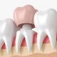 Dental Crowns