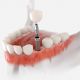Single Tooth Implant