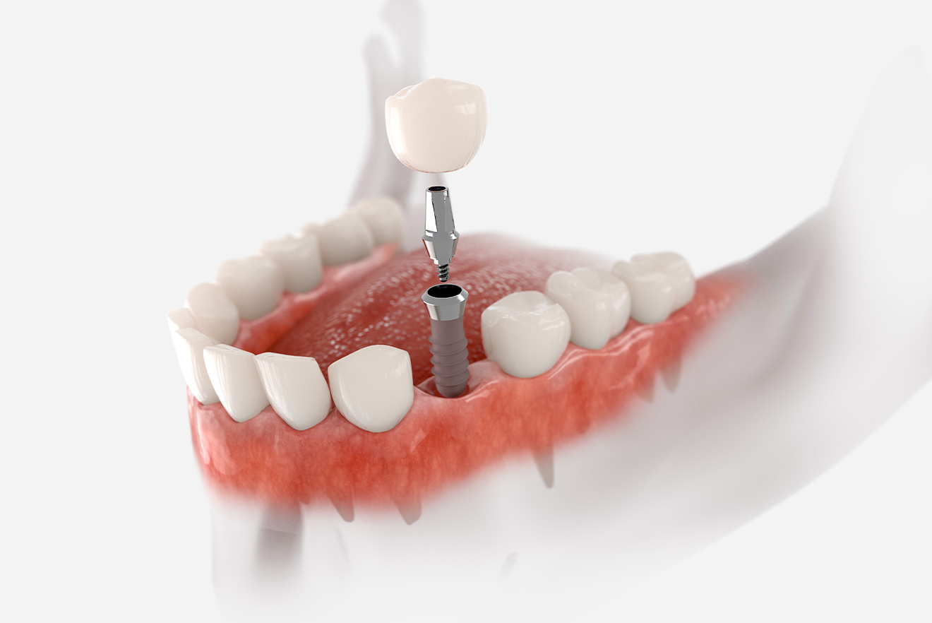 Single Tooth Implant Single Tooth Implant