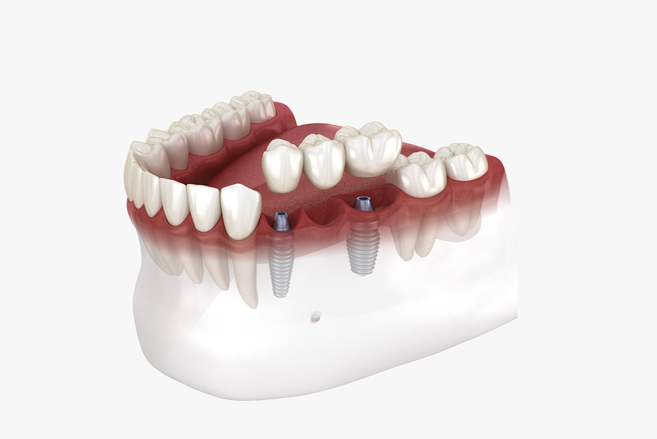 Implant to Support Bridge Implant to Support Bridge