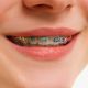 Conventional Metal Braces